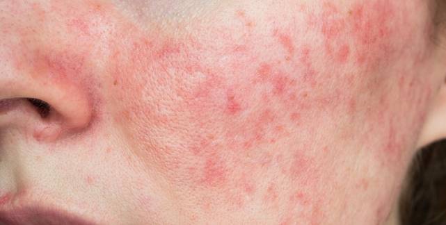 Dr. Yeung Ho Hong(楊浩康) explains Rosacea