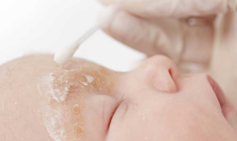 Dr. Yeung Ho Hong(楊浩康) explains the Treatments of Seborrhoeic Eczema?
